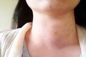 甲亢是什么？你了解吗？视频封面
