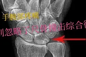引起手腕部痛的一个常见疾病，尺骨撞击综合征！很多人不知道！视频封面