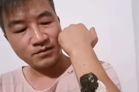 小妙招搞定皮肤残留黑膏药视频封面