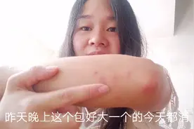 广州这边的这种虫子，叮一口特别痒，除虫剂也不管用！视频封面