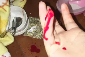 被仓鼠咬了之后会得狂犬病吗？会死吗？