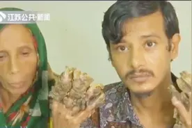 世界上真有树人?男子患上罕见怪病想截肢，双手如树枝不断生长视频封面