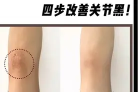 膝盖关节黑怎么办，不说别人还以为我没洗澡，四招教你关节变白视频封面