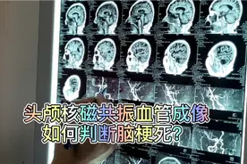 头颅核磁共振血管成像，快速判断脑梗死，很实用！视频封面