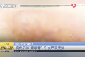 泰国进口“青草膏”网上卖得火，患者轻微烫伤后涂抹，更严重了！