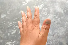 昨天下午被打眼机的气压压到手，手指头都肿了