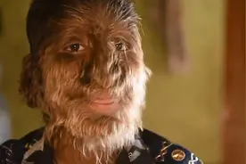 印度小男孩患奇病，脸上长满了毛发，其他孩子们的举动温暖了他视频封面