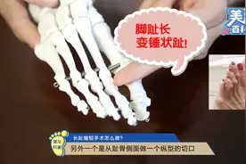 脚趾太长，穿鞋顶脚，怎样缩短？