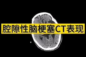 腔隙性脑梗塞常见病CT表现，自学教程，零基础学影像