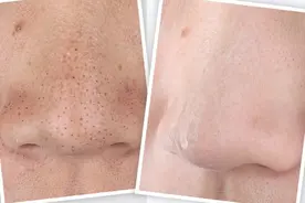 爽！黑头全部消除 毛孔缩小！最全的美容院秘密去黑头方视频封面