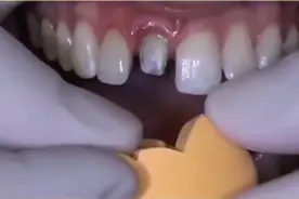 补牙的朋友们，可以看看临时牙套制作过程，即密封又好看