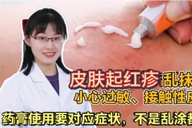 皮肤起红疹乱抹药膏，小心过敏、接触性皮炎，药膏使用要对应症状视频封面