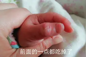 一岁的小宝经常喜欢吃手指，如今手指都烂啦，心急如焚，被告知…视频封面
