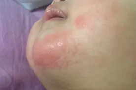 宝宝下巴反复出红疹，药也用不少，老人说的偏方也试过了，不见好视频封面
