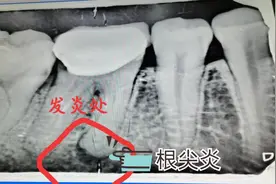小伙牙痛去牙科检查医生说根尖炎，引起原因跟大伙说说要注意