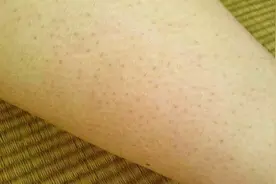 身上的鸡皮肤太难看了，教你最简单有效的去除方法，用过的都说妙