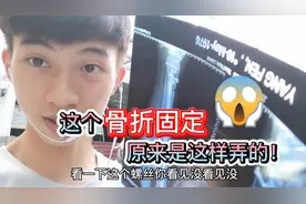 第一次看见骨折固定！钢钉和钢板原来是这样用的，太吓人了！视频封面
