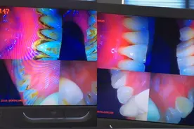 奔着拔智齿去的，却痛快的洗了一次牙，挺酸爽的，不过的确需要洗