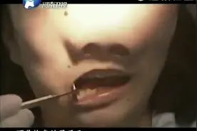 拍客：女孩长了一张青蛙脸，成天蒙面不见人，医生表示第一次见！视频封面