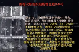 每日影像#朗格汉斯组织细胞增生症，误诊一例。视频封面