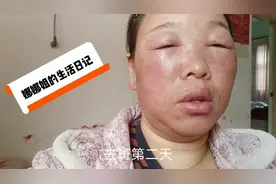 娜姐这回遭大罪了，脸肿的不成样，还流毒水。视频封面