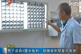 新余：男子误吞4厘米鱼刺 肠膜被刺穿差点丧命视频封面