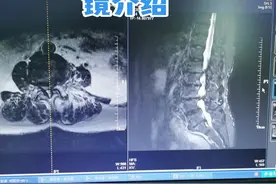 长节段融合与小孔镜各有适应症，微创术后如何保养，看看介绍#医学影像 #手术 #医学科普 #微创手术 #健康 #内窥镜 #腰椎管狭窄 视频封面