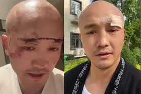 武僧一龙被不明身份人员偷袭，眉骨开裂4厘米，疑同门师兄弟所为视频封面