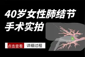 40岁女性查出肺结节，医生实拍手术过程视频封面