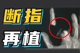 【科普】断 指 急 救 指 南 ！视频封面