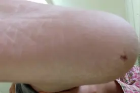 尿毒症肥娟，冬天脚跟冻到开裂流血，怀念小时候光脚，淋菜的时代