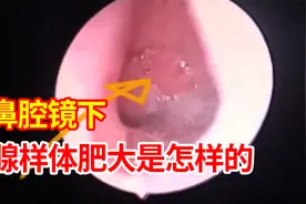 5岁小孩过敏性鼻炎，腺样体面容明显，带大家看看鼻子里的腺样体视频封面