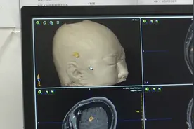 广东一女子脑里长寄生虫，竟与这个饮食习惯有关视频封面