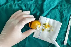 如果你的皮肤上长了一个脓肿，应该这样处理它。视频封面