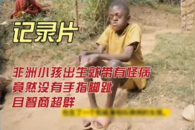 非洲小孩一出生就带有怪病，竟没有手指脚趾，且智商超群视频封面
