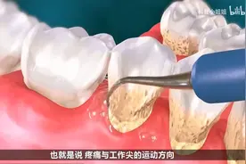 洗牙为什么那么疼？3D效果揭秘其中原理！视频封面
