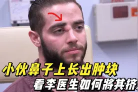 小伙鼻子上长出肿块，李医生直接将其挤爆，过程十分解压下饭！视频封面