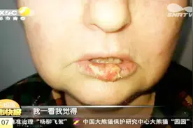混血大妈嘴上长溃疡，以为上火可怎么都不好，医院一查绝望了视频封面