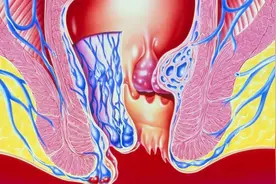 十男九痔，十女十痔？医生坦言：得了痔疮，这4种食物要少吃视频封面