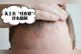 头上长“红疙瘩”，很可能是这几个原因，最好了解一下视频封面