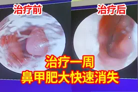 鼻腔镜对比：鼻炎治疗一周，女孩鼻甲肥大快速消失，鼻血也止住了视频封面