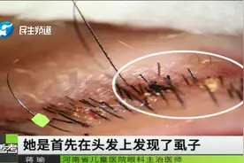 3岁多女娃眼睛痒，到医院检查吓一跳！寄生虫在睫毛上安了家视频封面