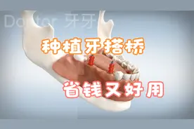 多颗牙缺失了解下种牙搭桥，省钱又好用，动画科普是怎么样的过程视频封面