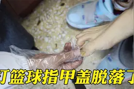 男子打篮球指甲盖和肉分离了，医生：没大问题，会长出新的指甲视频封面