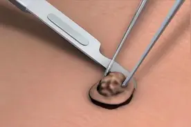 去痣手术怎么做？3D动画模拟全过程，看完你还敢去吗！视频封面