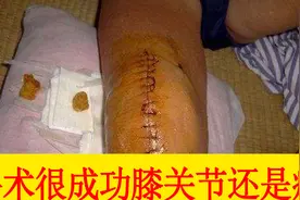 手术做得很成功，为什么患者膝关节仍是疼痛，你给的不是他需要的视频封面