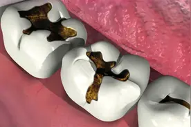 蛀牙真是被“虫子”吃光的吗？3D动画解释原理，今天可算知道了视频封面