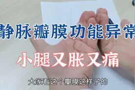 小腿又胀又痛，久站症状加重，肖教授生动讲解静脉瓣膜功能问题视频封面