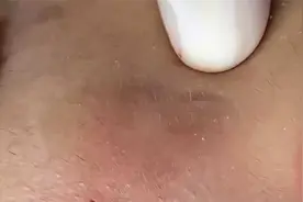 挤黑头，解压视频不喜误入，#强迫症 #极度舒适视频封面