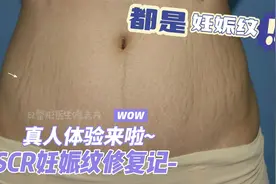 这样的妊娠纹修复方法，你见过吗？来感受一下修复过程！视频封面